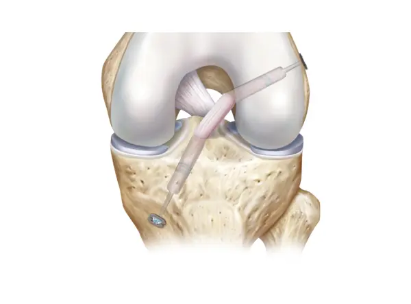 Results Of ACL Reconstruction