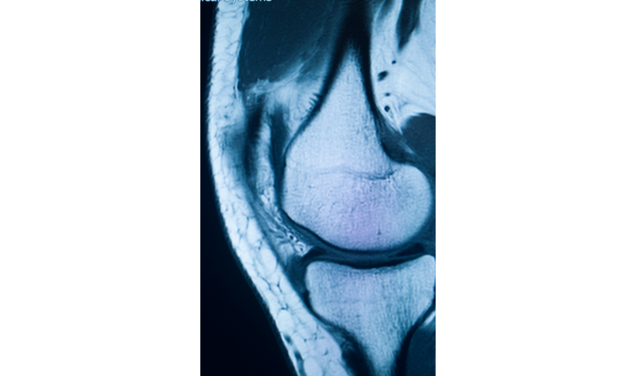 X-Ray Showing knee after ACL Suregry