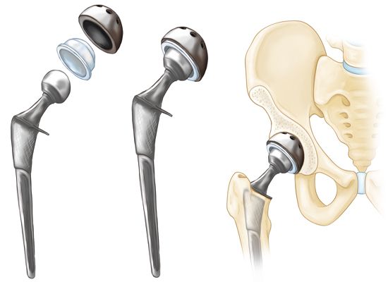 Component Attached During Hip Replacement